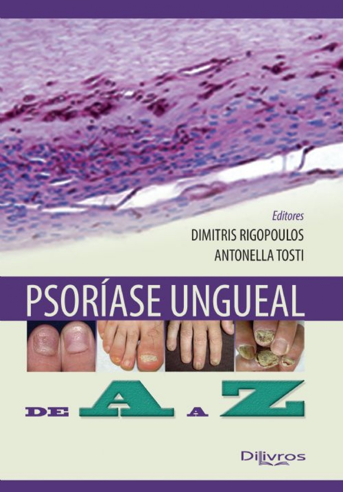 Psoríase Ungueal De A A Z