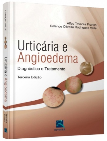 Urticária E Angiodema  Diagnóstico E Tratamento