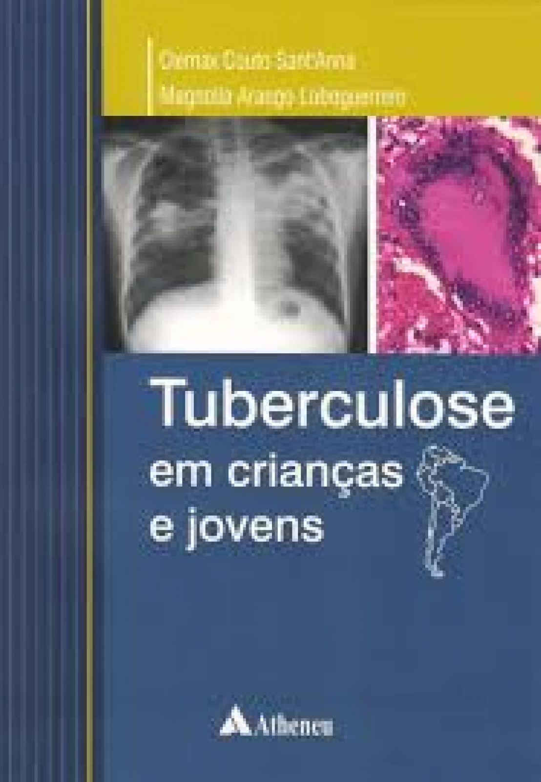 Tuberculose Em Crianças E Jovens