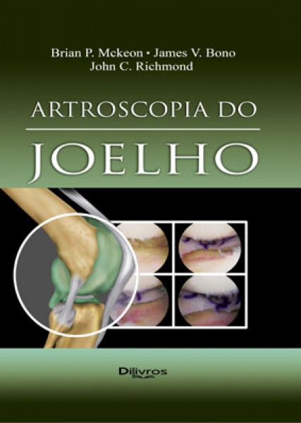 Artroscopia Do Joelho