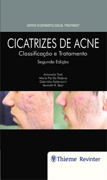 Cicatrizes De Acne