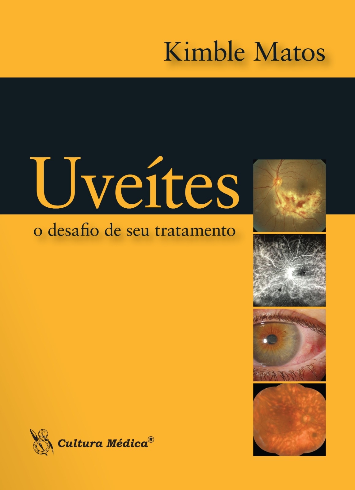 Uveítes - O Desafio De Seu Tratamento