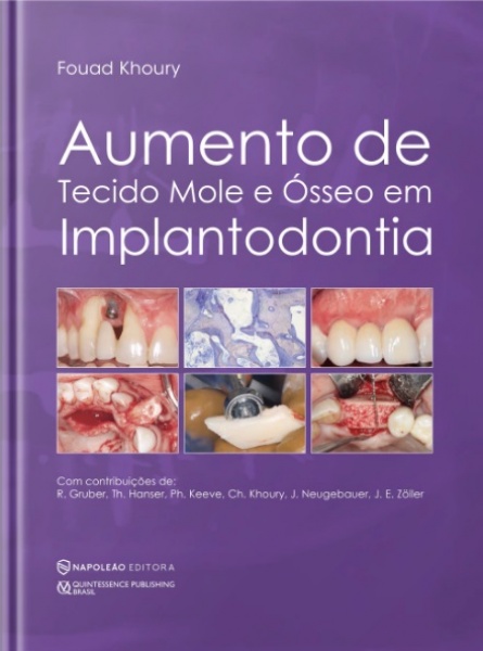 Aumento Ósseo E Tecido Mole Em Implantodontia