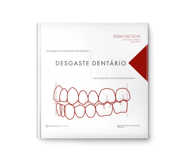 Desgaste Dentário - Abordagem De Tratamento Interceptativo Com Protocolos Minimamente Invasivos