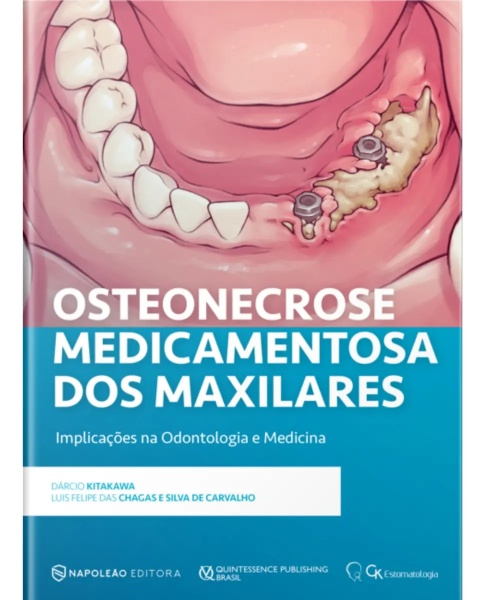 Osteonecrose Medicamentosa Dos Maxilares - Implicações Na Odontologia E Medicina