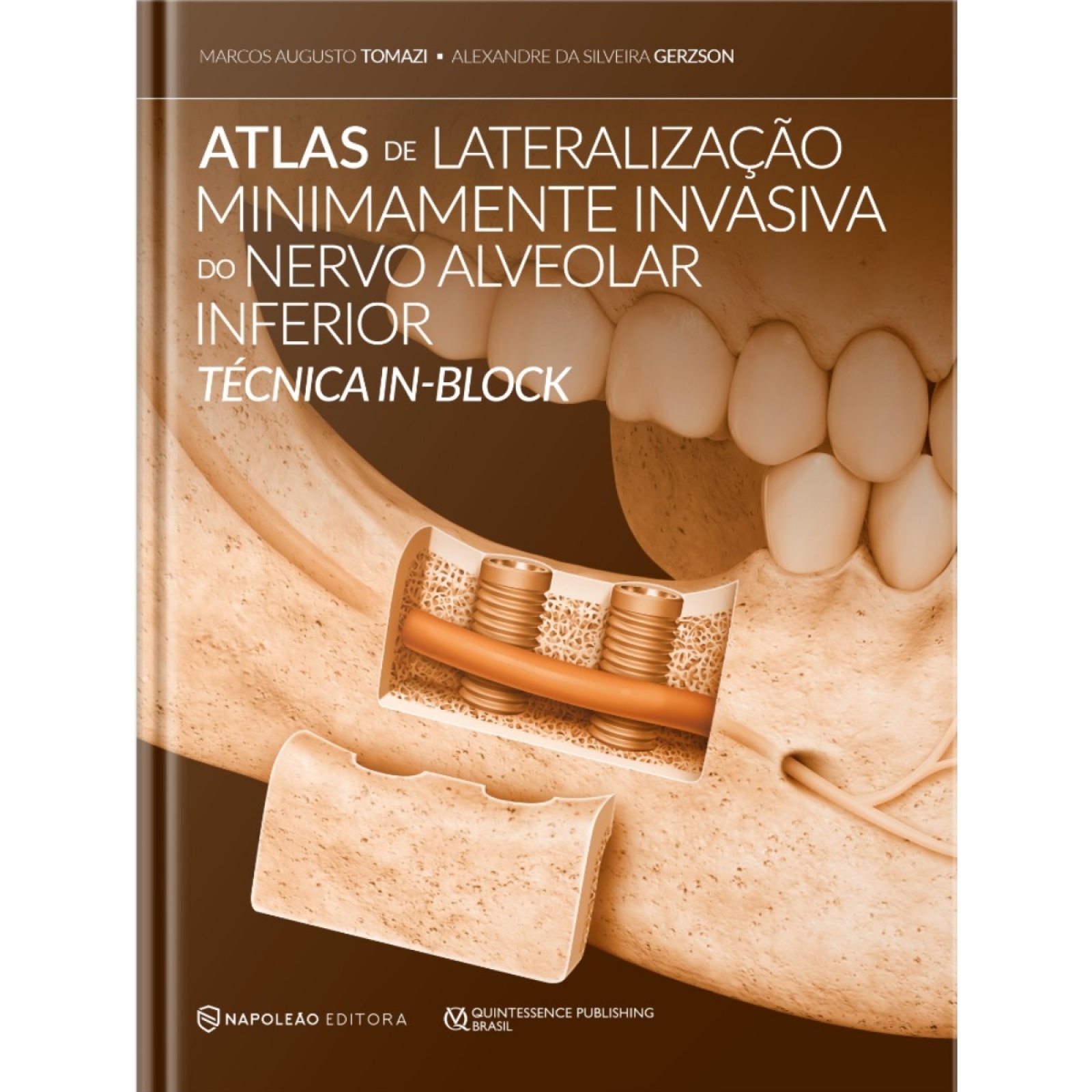 Atlas De Lateralização Minimamente Invasiva Do Nervo Alveolar Inferior Técnica In-Block