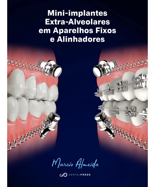 Mini-Implantes Extra-Alveolares Em Aparelhos Fixos E Alinhadores