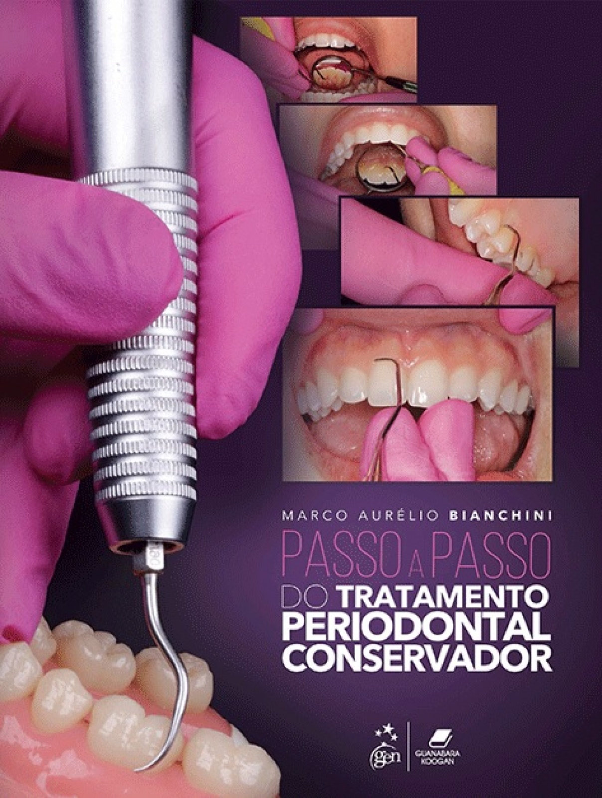 Passo A Passo Do Tratamento Periodontal Conservador